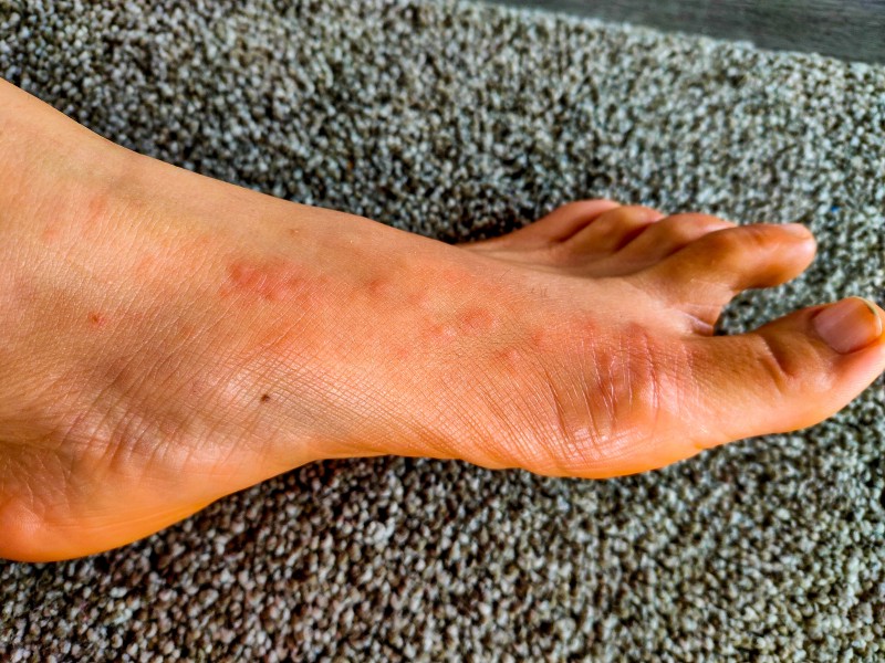Amys foot rash v2